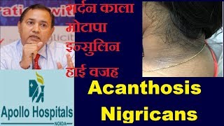 Acanthosis Nigricans Causes Treatment Delhi Significance High Insulin Dr B K ROY [upl. by Thordia]