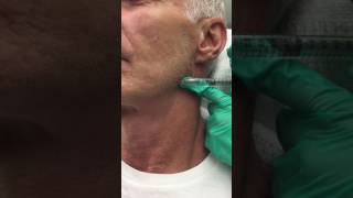 Juvederm Voluma Filler for the Jawline [upl. by Esnahc975]