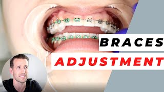 Orthodontist Explains Monthly Adjustments  Monthly Visits [upl. by Selrhc312]