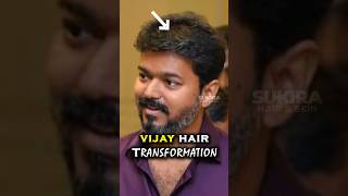 Actor Vijay Hair Transplant Results  Tamil Hair Transplant shorts hair celebrityhairtransplant [upl. by Adey]