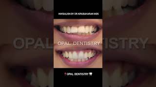 Invisalign by DrKirubaharan at Opal dentistry for a patient who has had previous braces and crowns [upl. by Intirb]