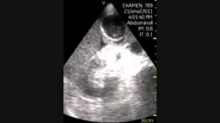 VSCAN Cholecystitis pocket ultrasound Colecistitis aguda eco de bolsillo [upl. by Oicnoel]