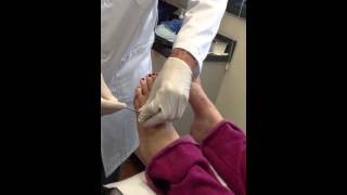 5th Metatarsal Pin Removal [upl. by Sredna]