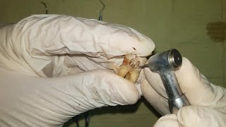 Management of deep caries using partial caries removal technique practical عربي [upl. by Assillam]