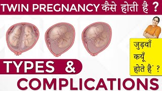 Twins Pregnancy Types Dichorionic Conjoined Monochorionic Diamniotic Monochorionic Monoamniotic [upl. by Agnese239]