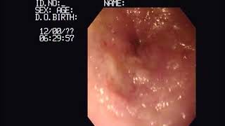 Video 2 Collection of duodenal biopsy samples via endoscopy [upl. by Leisam]