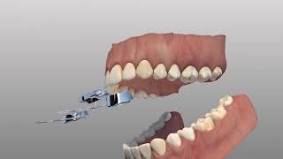 Rapid Palatal Expander [upl. by Nnahtur]