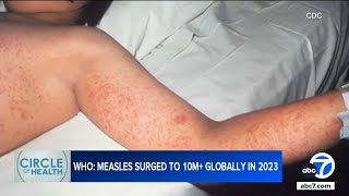 Amid global measles surge heres what LA County is doing right [upl. by Lledrev]