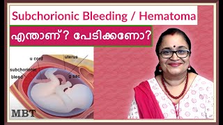 Subchorionic HematomaBleeding In Pregnancy What Is It Should You Be Afraidഎന്താണ്പേടിക്കണോMBT [upl. by Alyat]