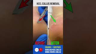 Heel Callus Removal [upl. by Meldon]