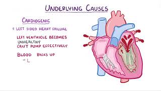 Pulmonary Edema causes symptoms diagnosis treatment pathology [upl. by Adnat]