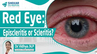 Episcleritis and Scleritis Symptoms Treatments Causes  Shekar Eye Hospital [upl. by Miltie]