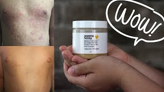 GET RID OF YOUR ECZEMA  ECZEMA HONEY HEALING CREAM [upl. by Atlante]