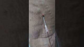 Varicose Veins treatment by Dr Hussain at Hussaingreekcliniccom without surgery drhussain [upl. by Arvin]