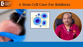 Stem Cell Treatment For Hair Loss Revolutionary Hair Therapy  DrVenkataram MysoreDoctors Circle [upl. by Ahsyad]