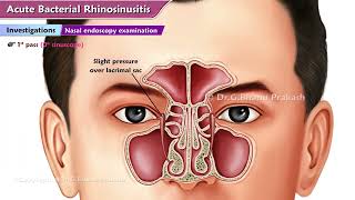 Acute Bacterial Rhinosinusitis ABRS  ENT Lectures [upl. by Etheline]