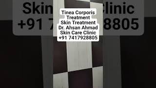 Tinea Corporis Treatment Skin Treatment Dr Ahsan Ahmad Skin Care Clinic91 7417928805 [upl. by Euqnomod111]