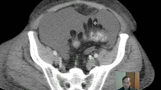 CT Epiploic Appendages Discussion [upl. by Arahahs375]