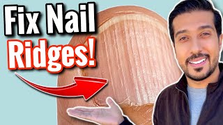 Vertical Ridges on Nails  What Are Your NAILS Trying to Say [upl. by Allertse132]