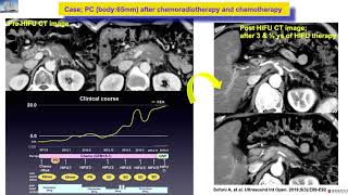 Sofuni  The Usefulness of HIFU Therapy for Unresectable Pancreatic Cancer Poster 2020 [upl. by Vonnie20]