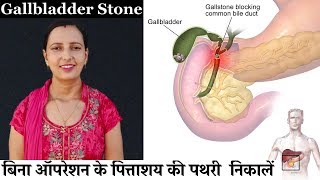 Gallbladder Stone removal  बिना ऑपरेशन के पित्ताशय की पथरी निकालें [upl. by Fording]