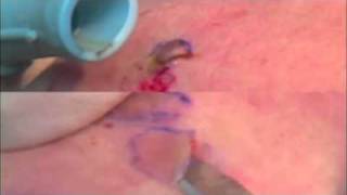 Dermatology Ellman RF vs Scalpel for Lesion Removal [upl. by Gowrie]