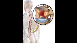 multiple bony lytic lesions [upl. by Emmit255]