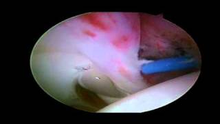 Labral Tear  Detached Anterior Labrum [upl. by Carin]