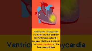 Ventricular Tachycardia heart shorts [upl. by Danyette]