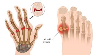 What is Gout Symptoms Causes Diagnosis Treatments [upl. by Sandon]