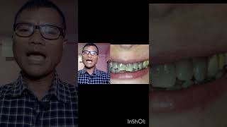 teethwhiteningpiriya teeth teethcleaning teethproblem sansational [upl. by Neerroc]