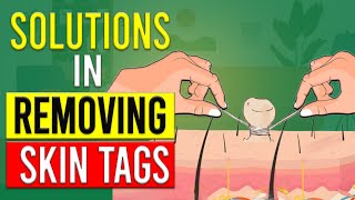 How to Remove Skin Tags Yourself [upl. by Artenehs957]