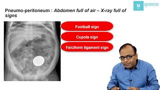 CONCEPTUAL RADIOLOGY ON MARROW  X ray signs in pneumoperitoneum [upl. by Anilesor]