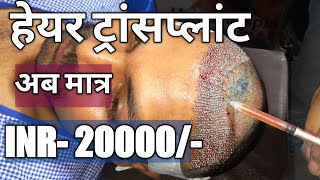 Best Hair Transplant Result at Lowest Cost In India  Latest Holi Offer  DrRajesh Sokhal [upl. by Ader]