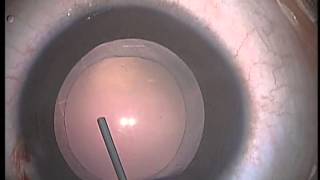 Pediatric Cataract Surgery Lens Aspiration PCCC Anterior Vitrectomy and IOL Implanation [upl. by Guglielma]