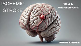 Brain stroke  What is Ischemic stroke Causes  Atherosclerosis condition Complete 3D Animation [upl. by Rawna]