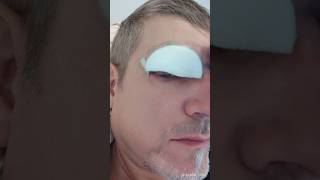 Augenlidstraffung Erfahrungen mit der Augenoberlid OP eyelid surgery [upl. by Tiebold231]