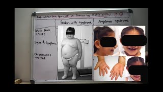 Disorders of Imprinting  PraderWilli Syndrome and Angelman Syndrome  USMLE step 1  Lecture 4 [upl. by Meda]