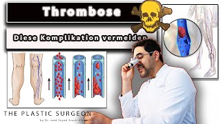 Die Thrombose und Lungenembolie erkennen als GEFÄHRLICHE Komplikation  Helfen Kompressionsstrümpfe [upl. by Meikah]