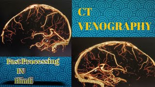 CT Venography Post Processing in Hindi ‎gehealthcare ​⁠ [upl. by Ebberta]