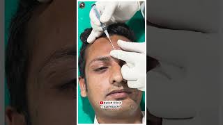 Unbelievable Skin Transformation After Subcision Treatment Awish clinic [upl. by Nafets]