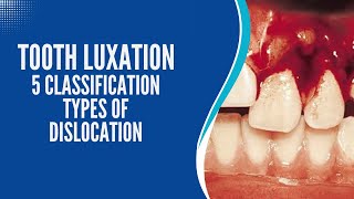 Tooth Luxation 5 Classification Types of Dislocation [upl. by Cynarra102]