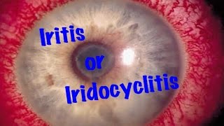 Medical Video Lecture Ophthalmology Iridocyclitis or Iritis Made simple [upl. by Kania]