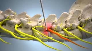 Spinal Nerve Block EN version [upl. by Iy]