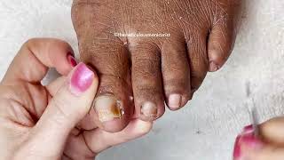 Lets Revisit  How to Pedicure on Tight Toenails [upl. by Hada]