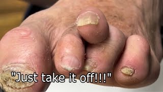 ❗️EXTREME❗️ HAMMER TOE TREATMENT [upl. by Kenney]