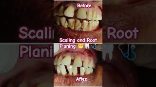 Oral Hygiene Scaling and Root planing conventional periodontal therapybdshorts dental smile [upl. by Dianne303]