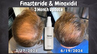 Hair Restoration  Month 3 Update using Topical Finasteride amp Minoxidil from hims [upl. by Bobinette]