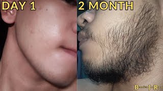 Minoxidil Beard Journey 2 MONTH TRANSFORMATION [upl. by Elleral351]