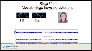 15 Mosaicism in r20 syndrome [upl. by Waldack]